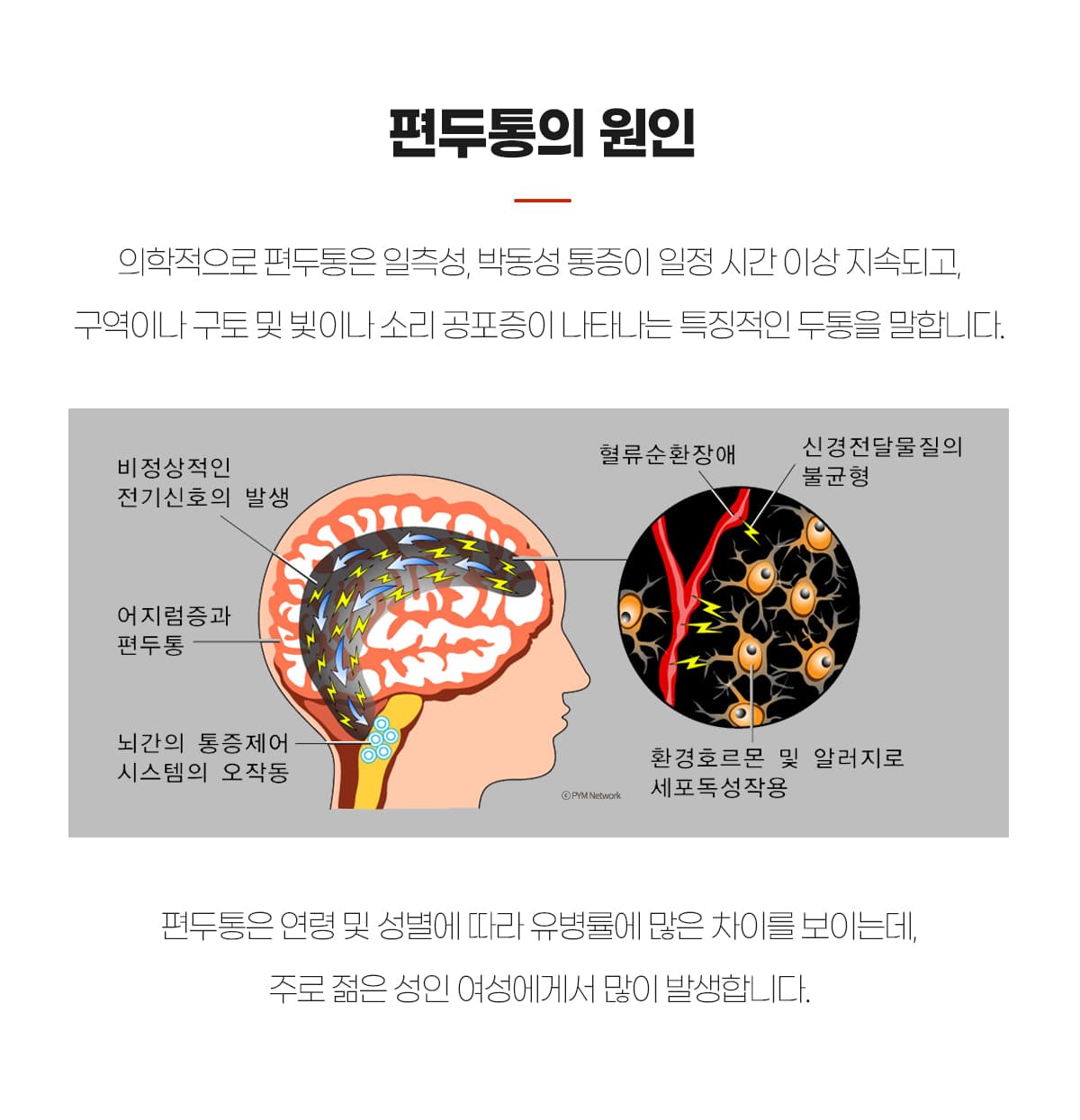 편두통 원인