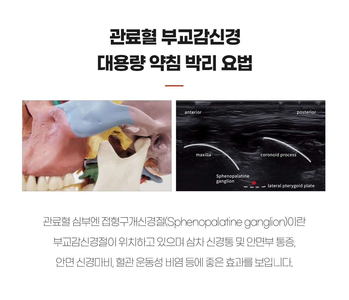 관료혈 약침박리