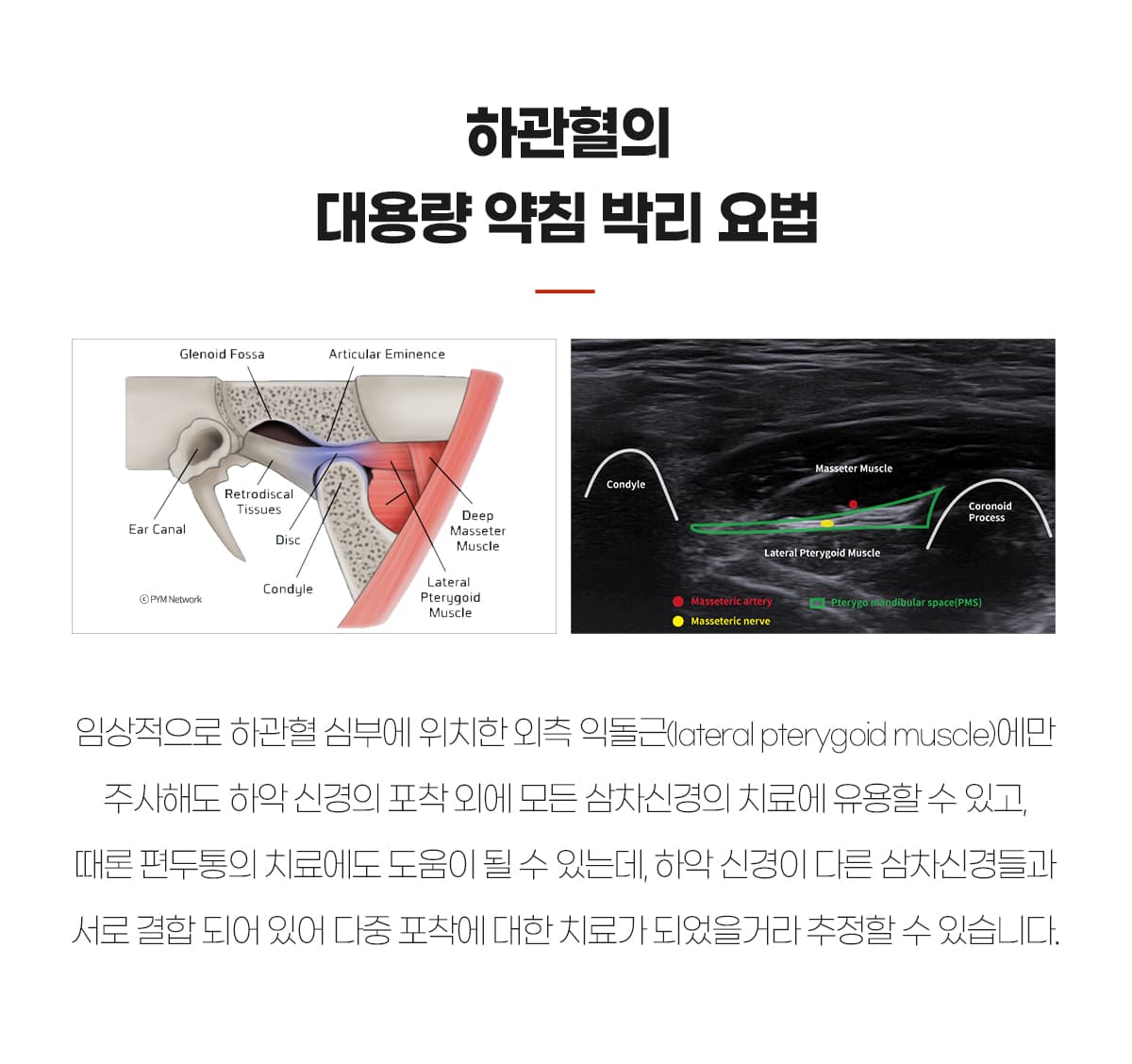 하관혈 약침박리