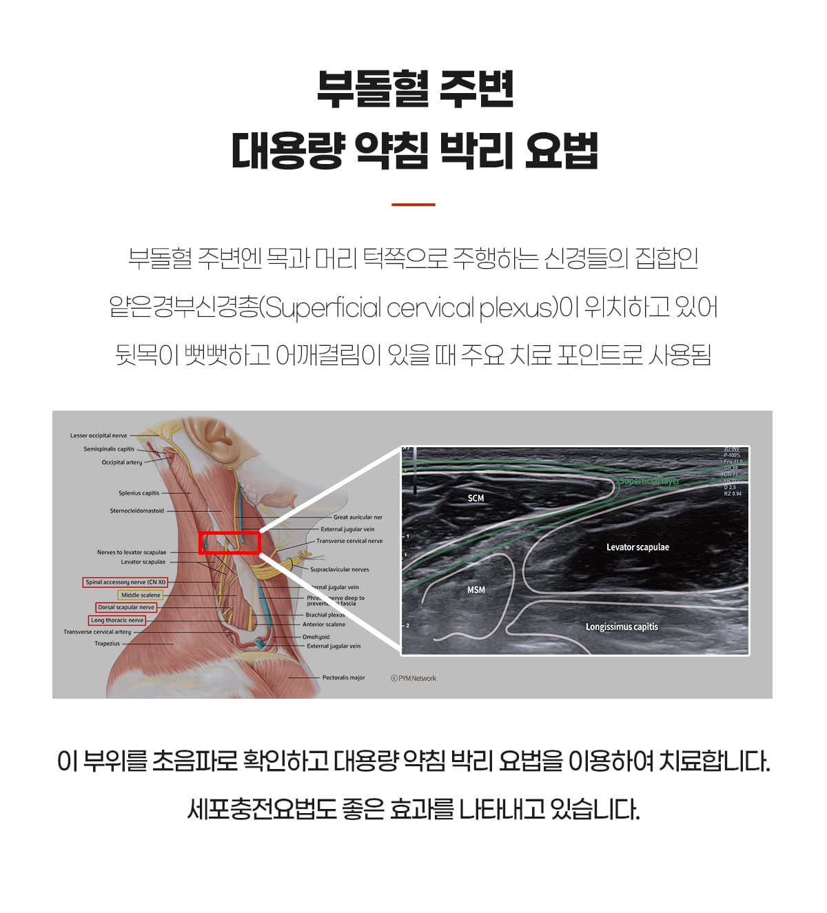 부돌혈 약침박리