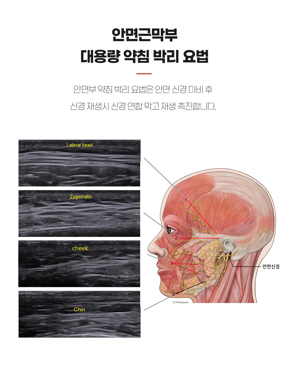 안면근막부 약침박리