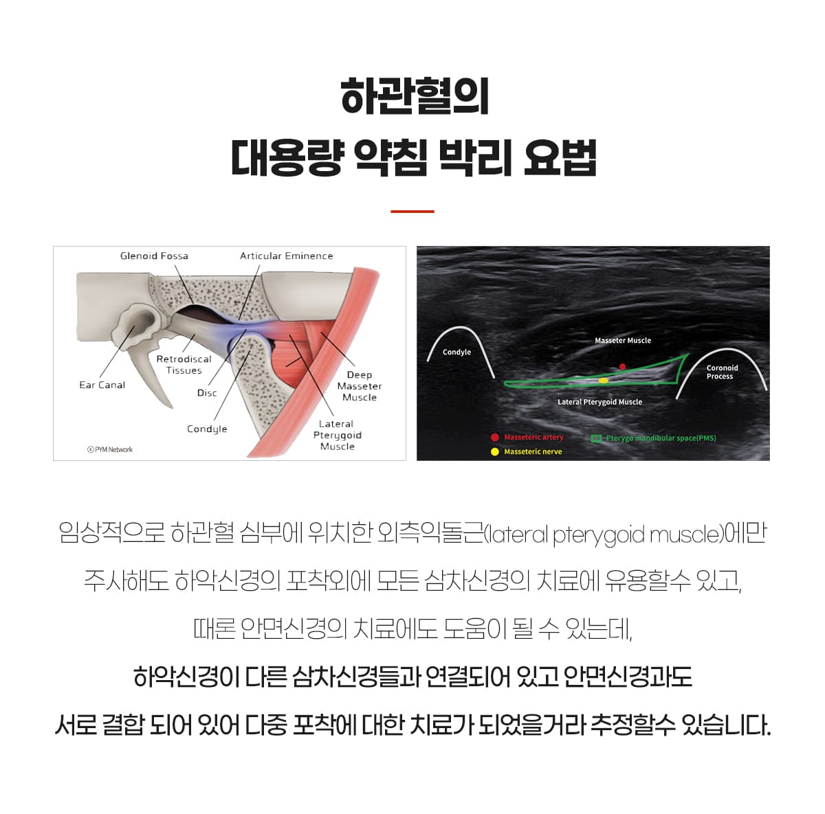 하관혈 약침박리