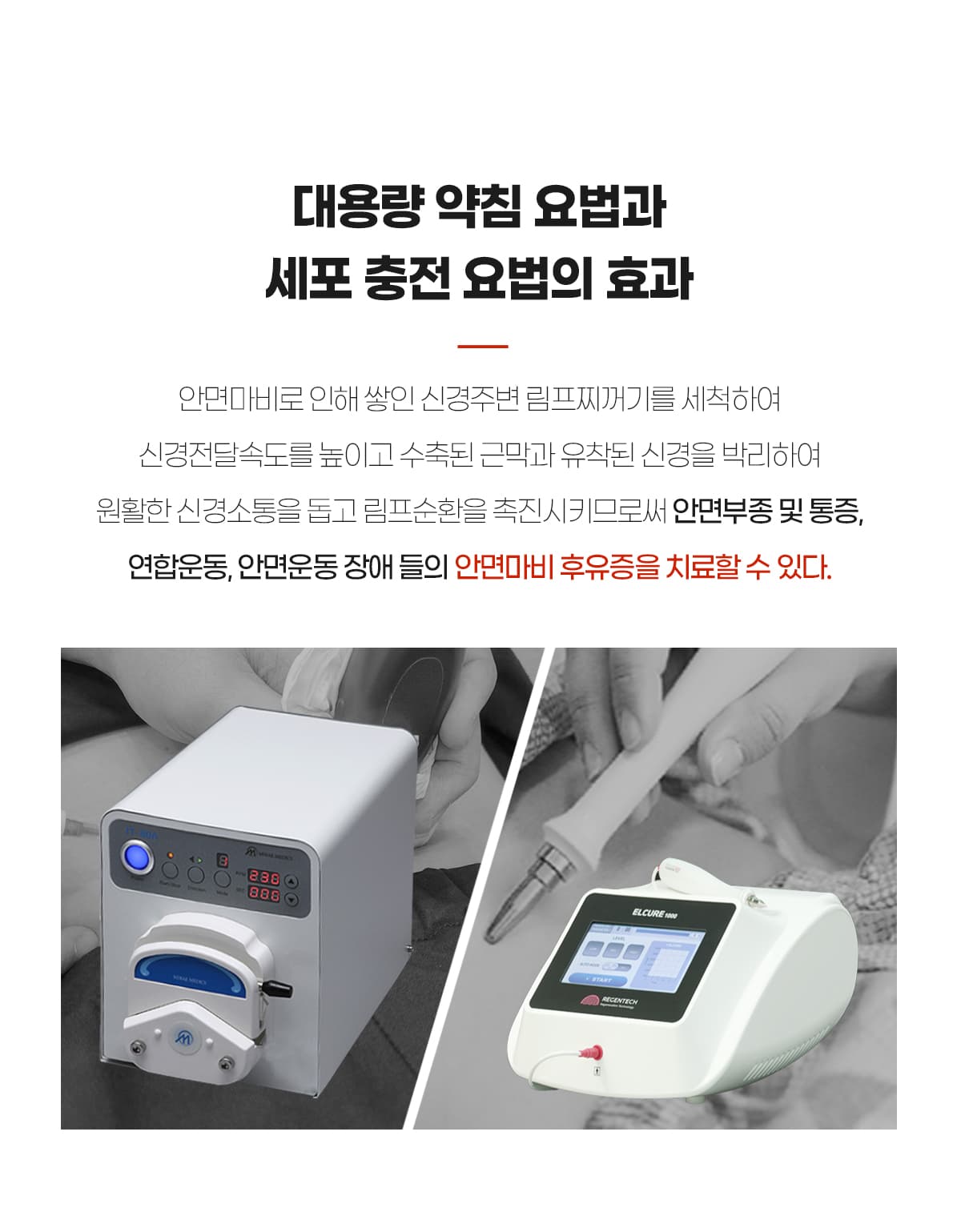 약침박리와 세포충전