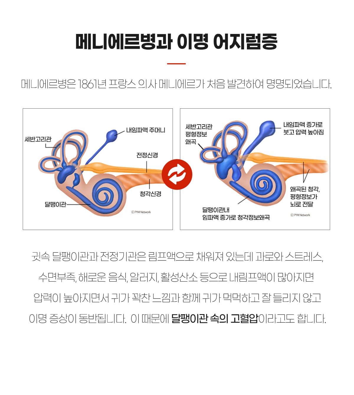메니에르병