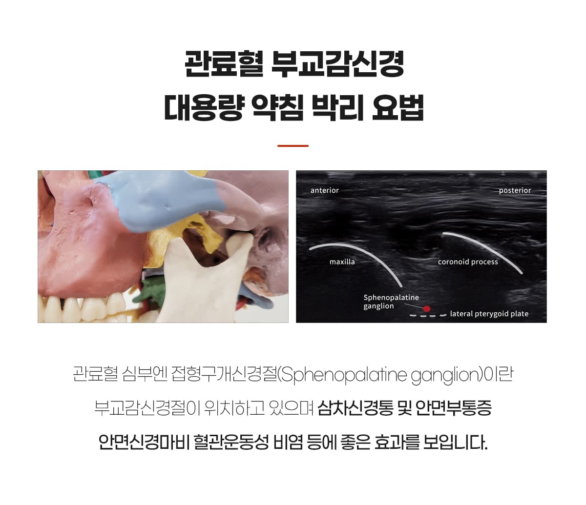 관료혈 약침박리