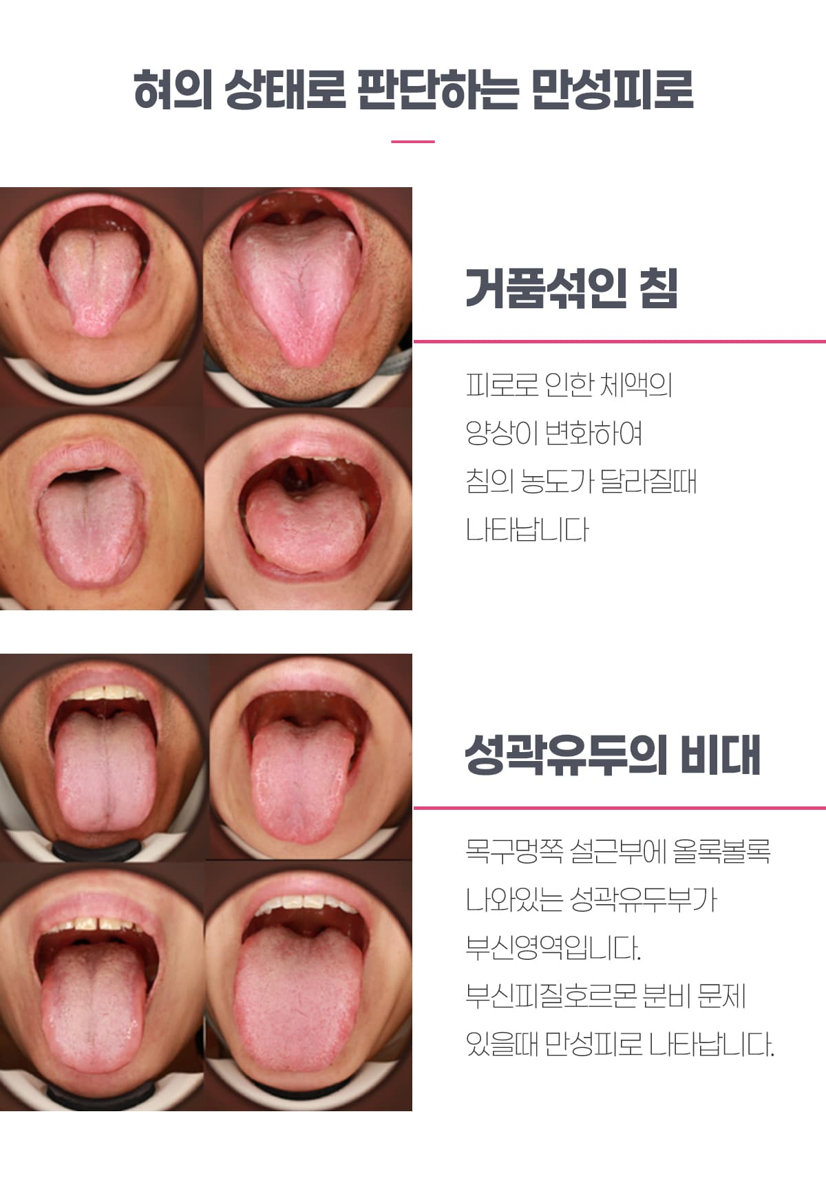 혀의 상태로 판단하는 만성피로