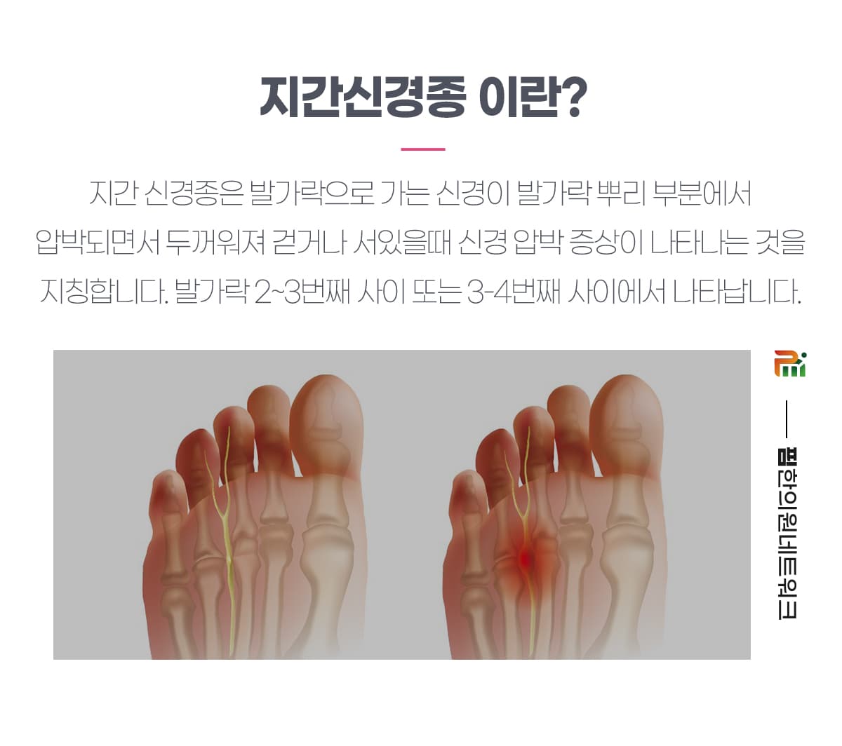 지간신경종