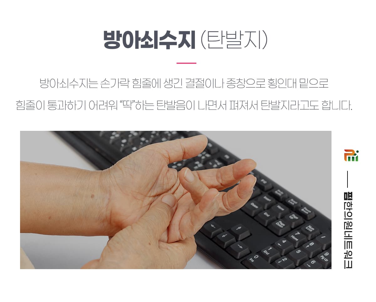 방아쇠수지(탄발지)