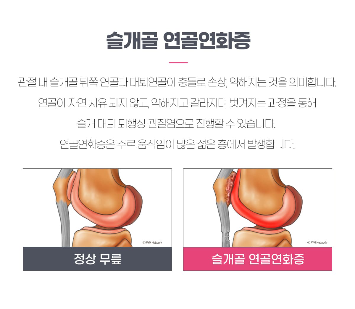 슬개골 연골연화증