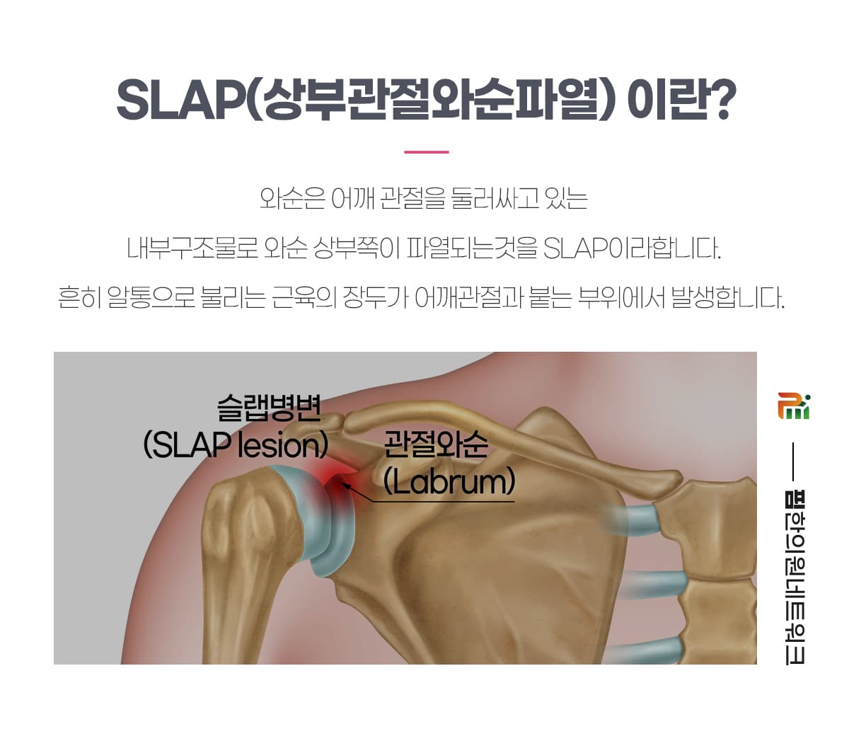 SLAP(상부관절와순파열)