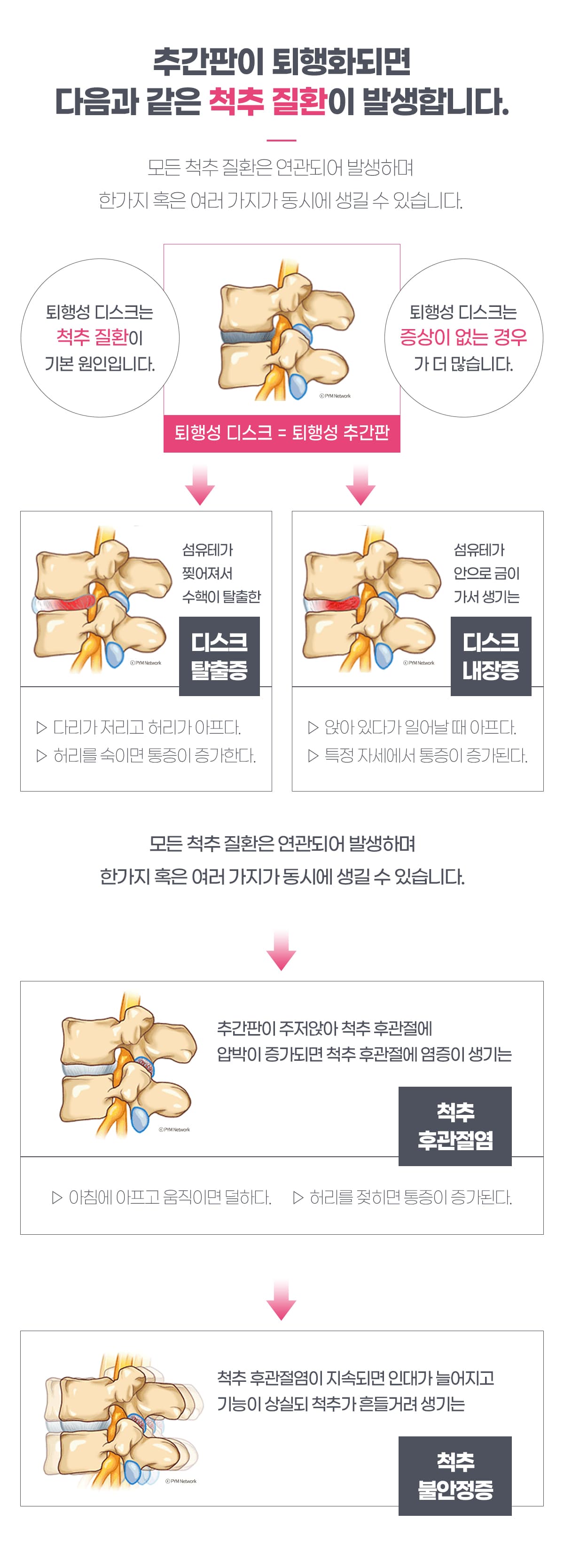 추간판 퇴행화