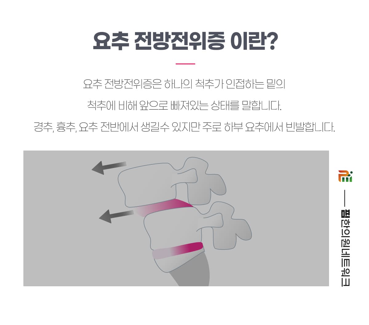 요추 전방전위증