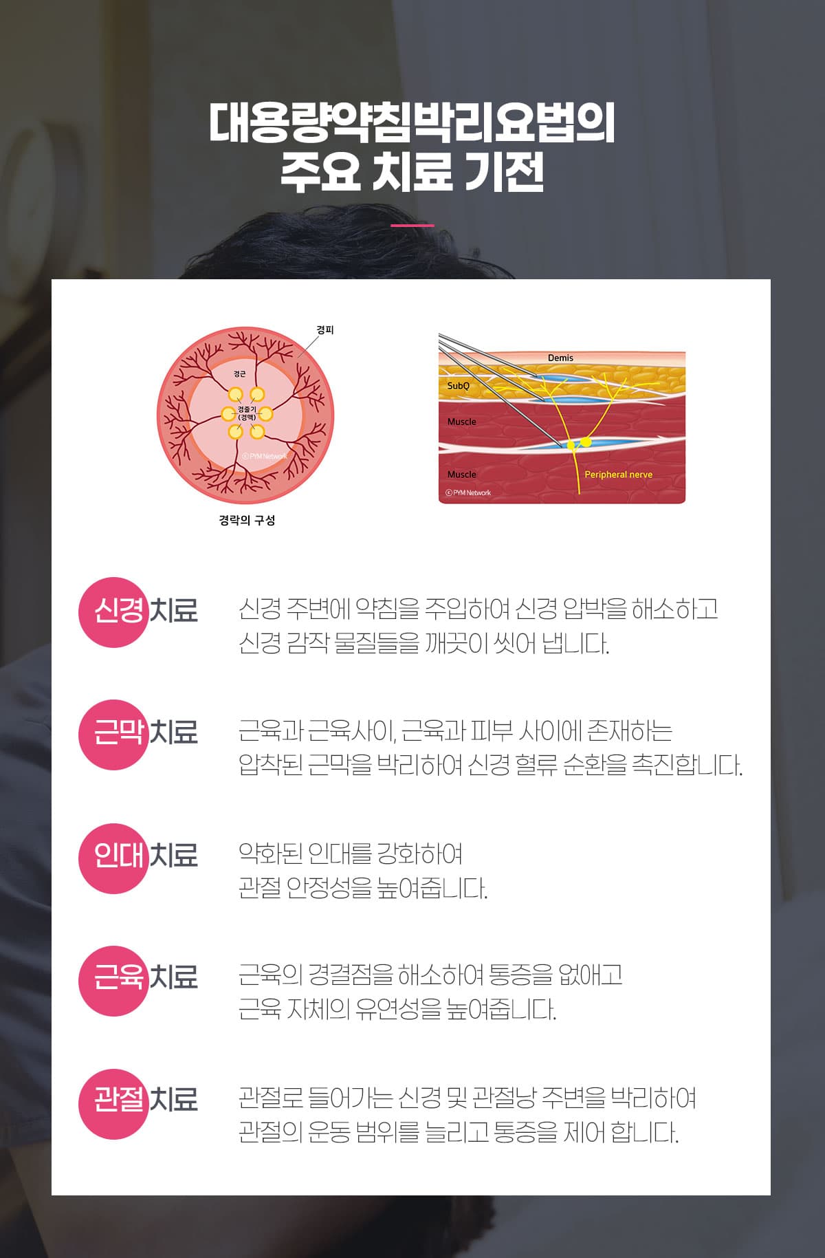 약침박리 치료기전