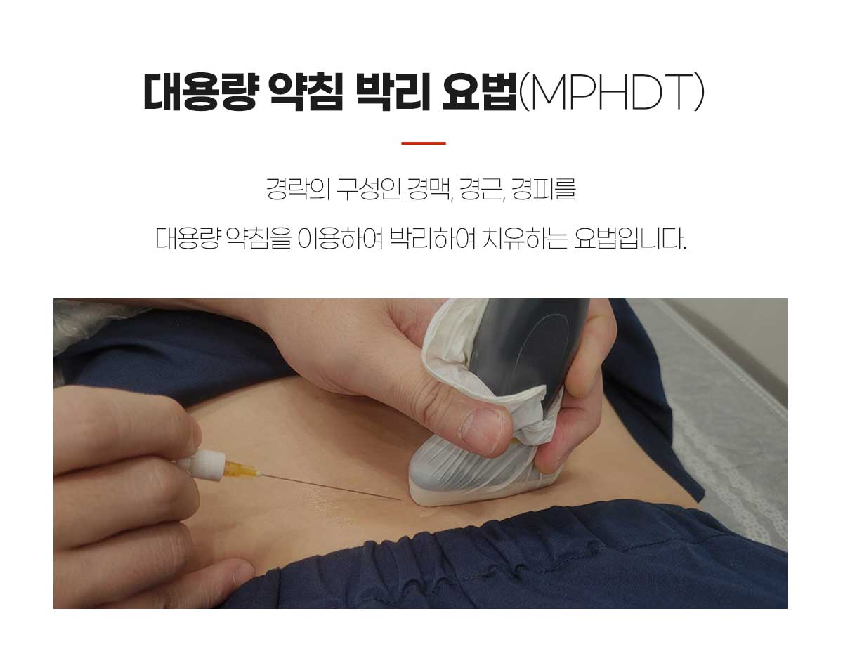 대용량 약침 박리 요법