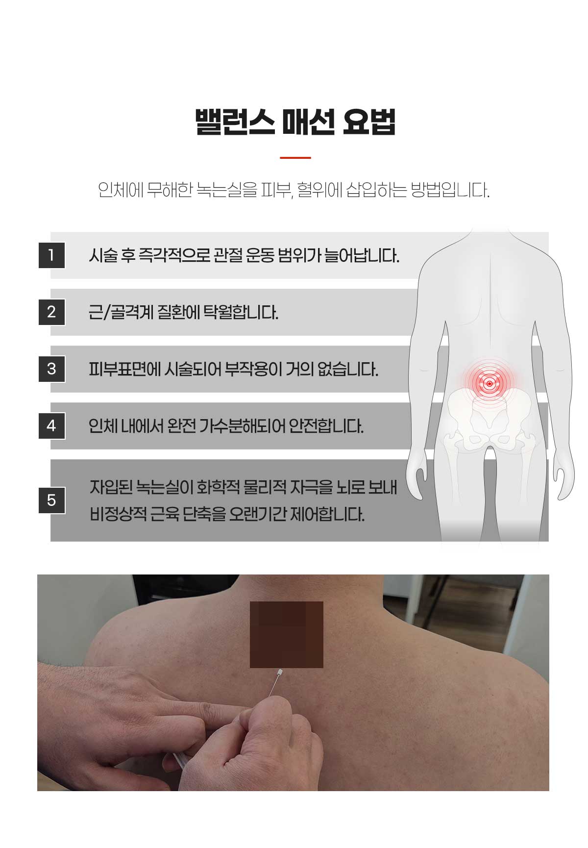 밸런스 매선요법